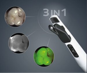 DIAGNOcam intraoralt kamera – Vision Full HD  (stand alone)